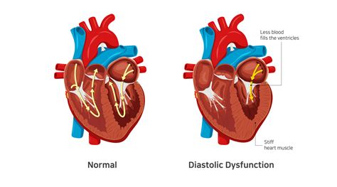 is impaired lv relaxation dangerous|what causes diastolic dysfunction in women.